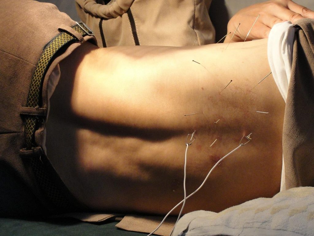 Professionele acupuncturist voert behandeling uit in Leiden kliniek voor pijnverlichting en gezondheid